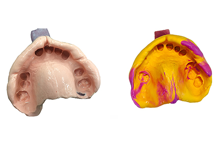 Alginate Impression or Silicone Impression