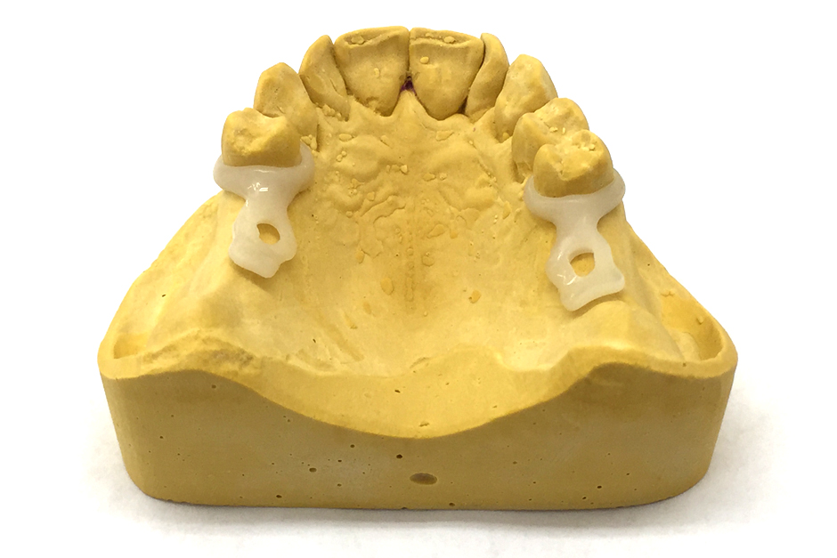 Acetal Resin Clasps for Acrylic Denture