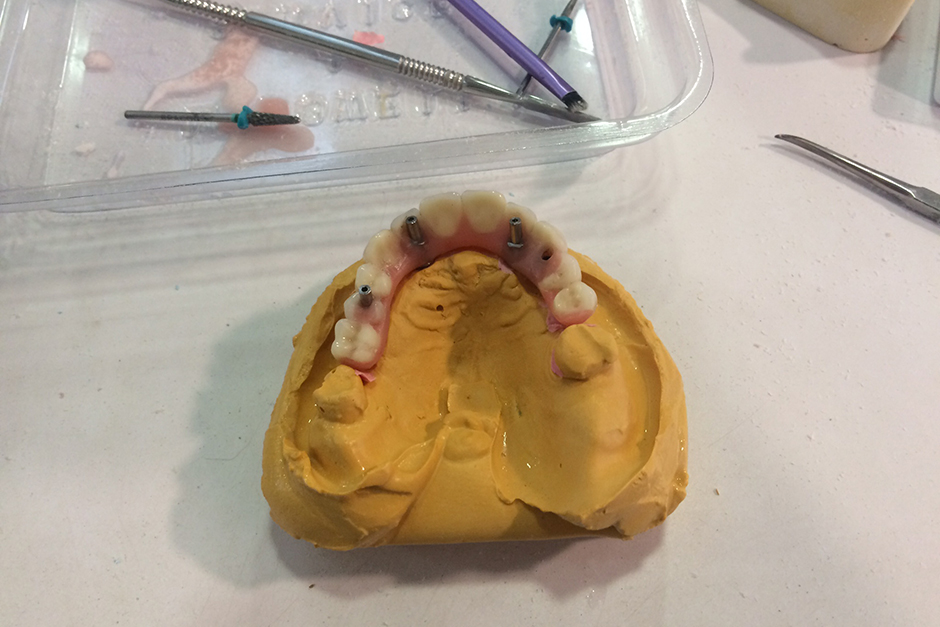 Upper immediate denture modified to pick up temporary cylinders and refined with palate removed to acrylic bridge.