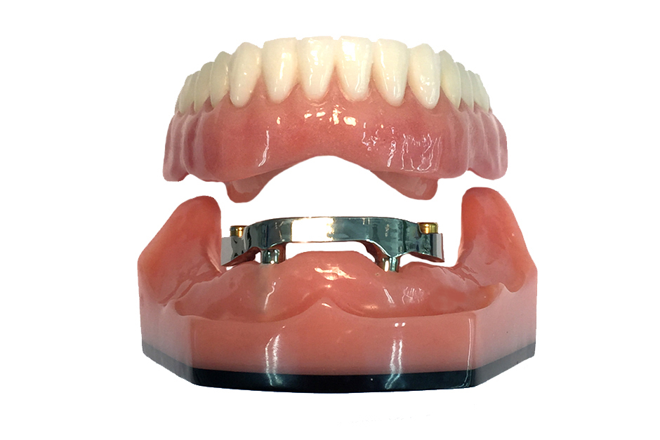 Overdenture Milled Beam with Locator Abutments