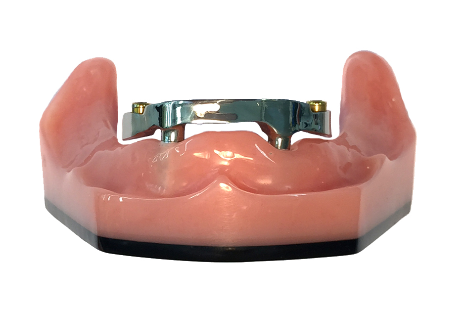Overdenture Milled Beam with Locator Abutments