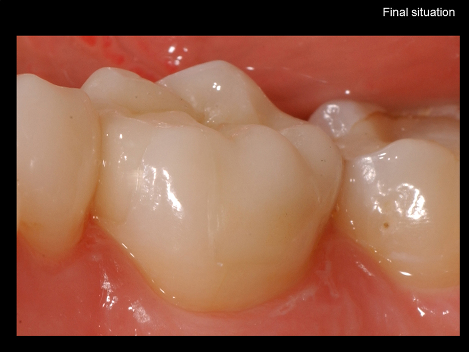 Adhesive Cementation of Lithium Disilicate IPS e.max Press