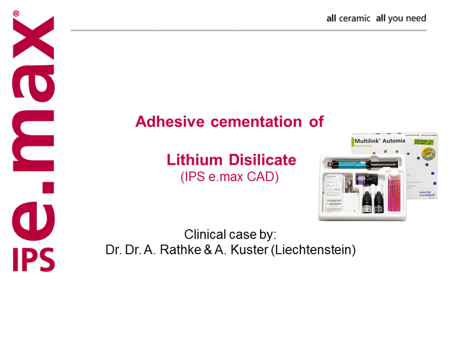Adhesive Cementation of Lithium Disilicate IPS e.max Press