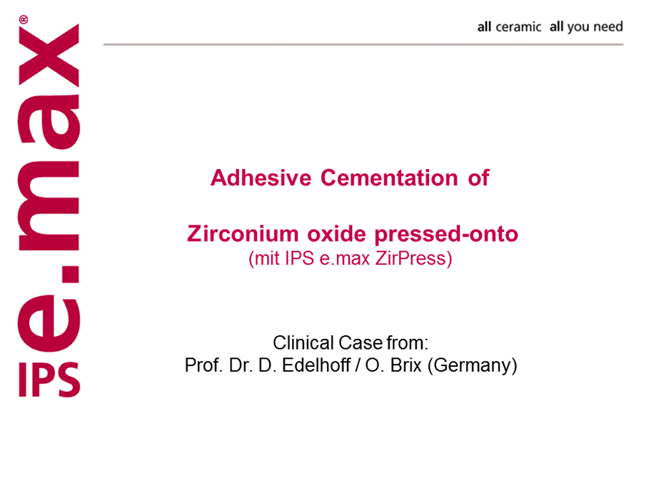 e.max Adhesive Cementation of Zirconium Oxide Pressed onto ZirPress