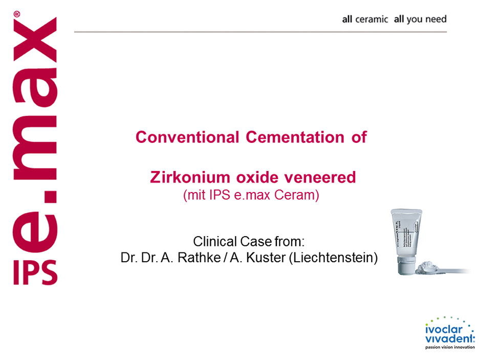 Conventional Cementation of ZirKonium Oxide Veneered e.max Ceram