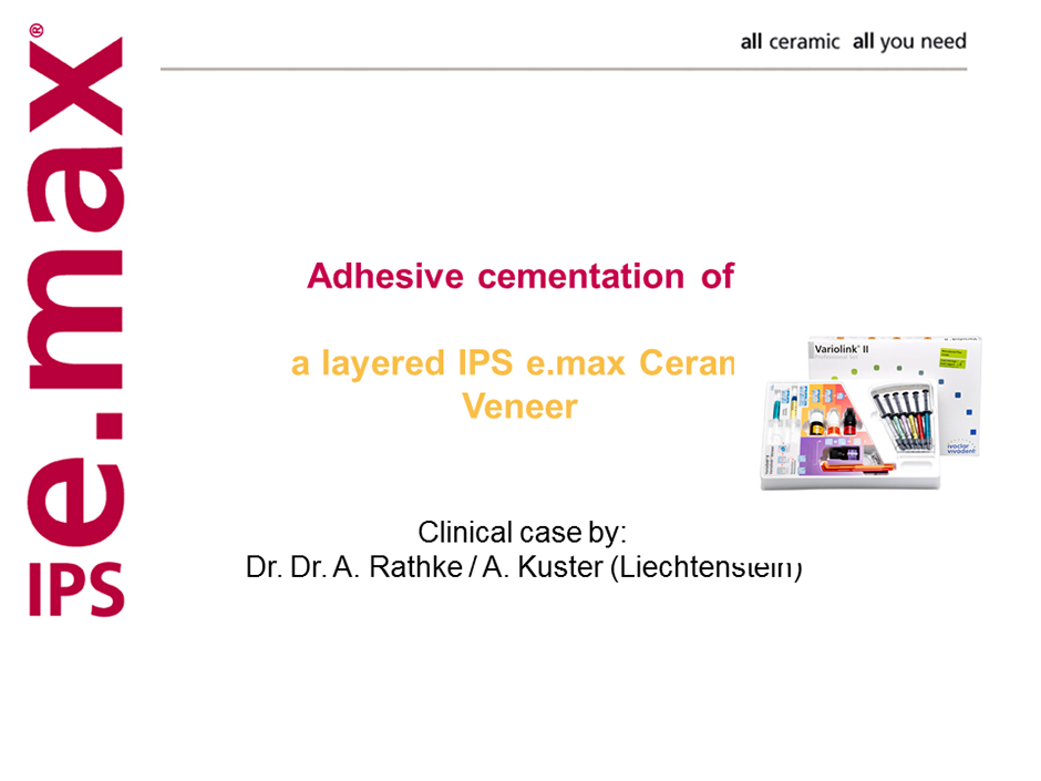 Adhesive Cementation of Layered IPS e.max Ceram Veneer