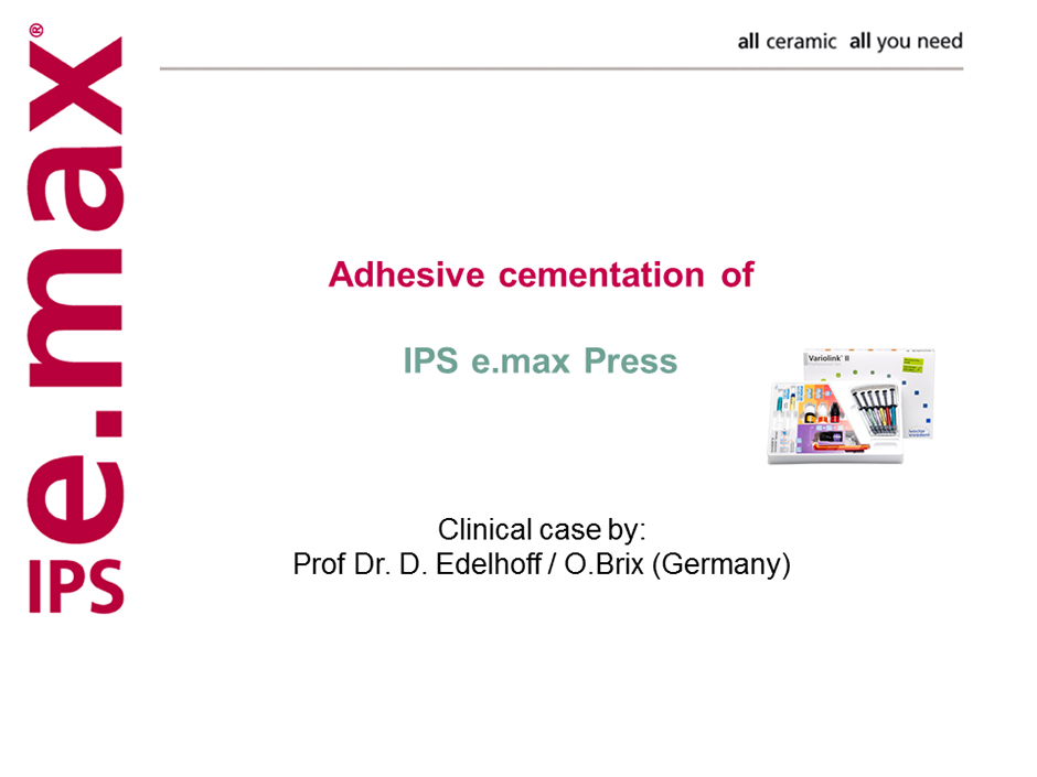e.max Adhesive Cementation of IPS e.max Press