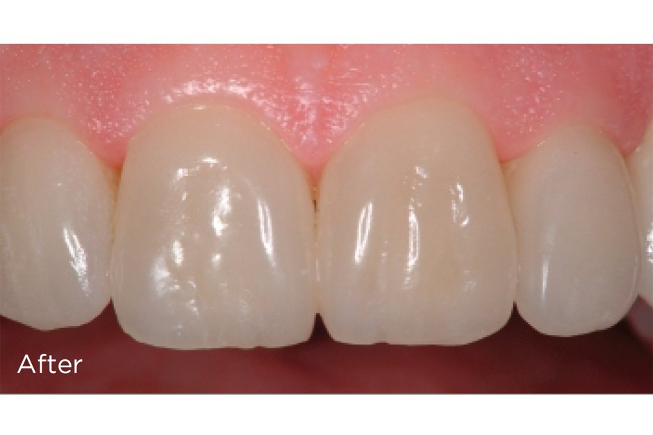 After Veneers and Fitted